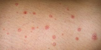 Trị viêm da dị ứng bằng phương pháp dân gian