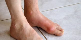 Chữa bệnh gout đơn giản từ các bài thuốc Đông y