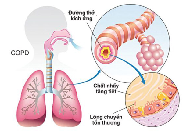 Lợi ích và cách sử dụng thuốc nam điều trị bệnh phổi tắc nghẽn mạn tính